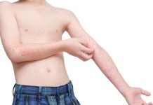 8.017 de cazuri de rujeolă, înregistrate până vineri, cu 370 mai multe față de săptămâna trecută! Timisul, LIDER nedorit